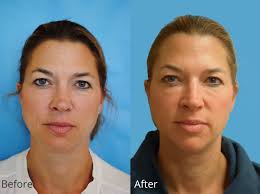 The Before And After Photos From A Recent Botox Patient Of Mine Notice How The Fine Lines And Wrinkles All But Dis Hair Removal Laser Hair Laser Hair Removal