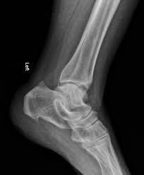 Interesting radiology cases from daily practice and a personal reference. Haglund Deformity Bony Prominence Is Seen On Postero Superior Aspect Of Calcaneal Tuberosity There Is Also Calcaneal Spur In In 2021 Ballet Shoes Shoes Dance Shoes
