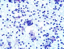 A review and update on recent progress. Hodgkin Lymphoma Concise Medical Knowledge