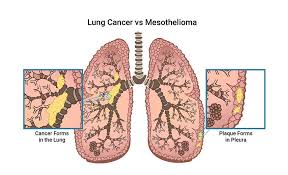 Asbestos Lung Cancer Causes Diagnosis Treatment