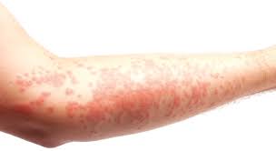 Learn about ciu & discover the facts every person living with chronic hives needs to know. Ø§Ù„Ø´Ø±Ù‰ Ø§Ù„Ù…Ø²Ù…Ù† Ø§Ù„Ø£Ø±ØªÙŠÙƒØ§Ø±ÙŠØ§ Ø§Ù†ØªÙØ§Ø®Ø§Øª Ø­Ù…Ø±Ø§Ø¡ Ø£Ùˆ Ø¨ÙŠØ¶Ø§Ø¡ ØªØµÙŠØ¨ Ø§Ù„Ø¬Ù„Ø¯ Ø§Ù„Ø¨ÙŠØ§Ù† Ø§Ù„ØµØ­ÙŠ Ù…Ù‚Ø§Ù„Ø§Øª ÙˆØ¯Ø±Ø§Ø³Ø§Øª Ø§Ù„Ø¨ÙŠØ§Ù†