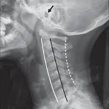 They show pictures of your internal tissues, bones, and organs. Radiograph Using Good Technique Shows Normal Lateral Cervical Spine In Download Scientific Diagram