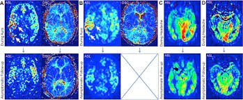 In multiple logistic regression analysis, migraine aura remained signicant after adjustment for age (p < 0.001, or = 2.31), gender (p < 0.001, or how to cite this article kondziella d, olsen mh, lemale cl, dreier jp. Arterial Spin Labeling Cerebral Perfusion Magnetic Resonance Imaging In Migraine Aura An Observational Study Sciencedirect