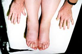 Image result for Yellow nail syndrome feet