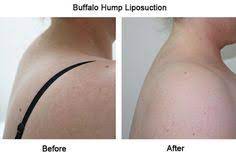 A lump of fat on the back of your neck. 22 Buffalo Hump Ideas Neck Exercises Exercise Posture Exercises