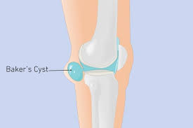 A special characteristic of the knee that differentiates it from other hinge joints is that it allows a small degree of medial and lateral rotation when it is moderately flexed. Pain Behind Knee Here S What It Could Mean The Healthy
