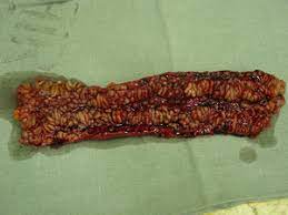 Morbus crohn oder colitis ulcerosa verursachen deutliche beschwerden (schmerzen, diarrhoe, häufiger stuhlgang, blut im stuhl). Morbus Crohn Biologie