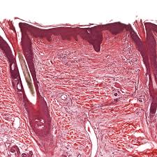 Maria trimarchi moles can appear at any time during your life. Skin Biopsies What You Should Expect News Yale Medicine