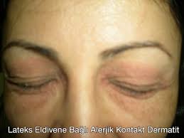 kimyasal madde alerjisi