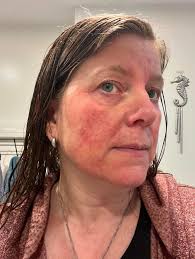 Are there any Canadian products I could use for my Rosacea?