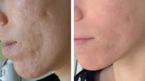 Image result for how much is a laser acne treatment