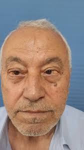 نتؤ الدهون تحت غشاء بياض العين هو حالة تدعى subconjunctival orbital fat  prolapse. هذا يحدث عندما تبرز دهون محجر العين إلى زاوية العين. هذه الظاهره  تكون لأسباب وراثية أو عند التقدم بالعمر لوجود ضعف في ...