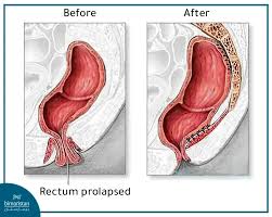 Image result for Rectal prolapse