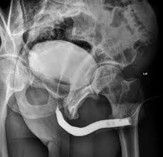 Image result for Retrograde Urethrogram