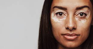 Vitiligo Treatment Experts in Virginia Beach, VA