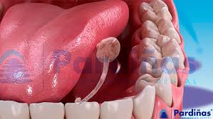 Image result for Sialoadenitis