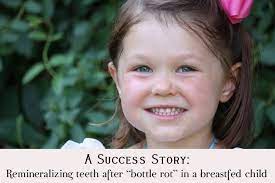 A Success Story Remineralizing Teeth After Bottle Rot In A Breastfed Child The Nourishing Gourmet Tooth Decay Baby Tooth Decay Tooth Decay In Children