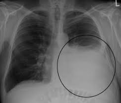 Image result for Thoracentesis