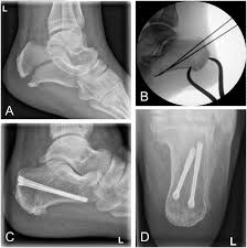 Image result for Calcaneus Compression Fracture