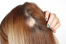 Image result for Alopecia