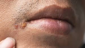 Image result for yellow scabs on the face in children