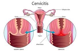 Pemeriksaan fisik pemeriksaan palpasi turut membantu menemukan nyeri tekan pada daerah sinus yang terkena disamping peme. Diagnosis Servisitis Alomedika
