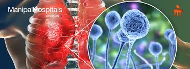 Maybe you would like to learn more about one of these? Black Fungus Infection Symptoms Treatment Causes Mucormycosis Black Fungal Infection In Covid 19 Patients Manipal Hospitals