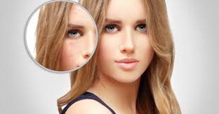 Daca iti provoaca mancarimi, nu te scarpina! Totul Despre Acnee Cauze Tratare Mituri