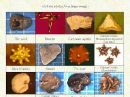 Types Of Stones Kidney Stones Kidney Body Health