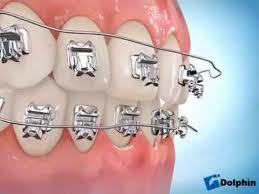 Damon System Youtube Dental Videos Orthodontics Youtube