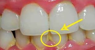 Plaque is formed due to early bacterial infection and may develop to form caries or even serious the plaque will harden over time and removal without professional help becomes impossible after a point. Calculus Is A Calcified Hardened Form Of Dental Plaque When Plaque And Bacteria Are Left On Your Teeth For Too Long It Begins To Harden On The Teeth And The Result Is