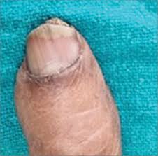 Image result for Onychotillomania feet