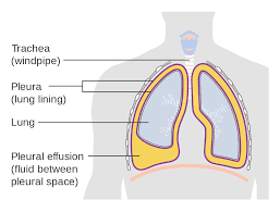 pleural effusion wikipedia