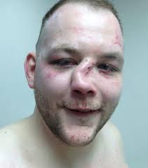 Das Tut Richtig Weh Die Ubelsten Mma Verletzungen Aller Zeiten