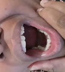 Gigi berlubang adalah kondisi ketika gigi membusuk karena makanan sisa tertinggal pada gigi. B5tspjh4o J4pm