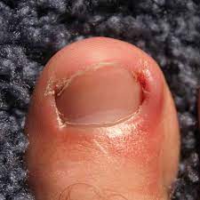 Cracked, thickened, yellow toenails (from a fungal infection) Ingrown Toenail Legacy Pediatrics