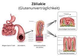In den meisten fällen tritt bereits wenige wochen nach der ernährungsumstellung eine besserung ein und die krankheitssymptome verschwinden. Zoliakie Ursachen Symptome Behandlung