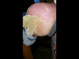 Check spelling or type a new query. Gross Dead Skin Peeling Off Foot 97 5 Kmod Big Mad Morning Show