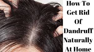 As skin cells die a small amount of flaking is normal; How To S Wiki 88 How To Remove Dandruff In Winter