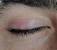 Ingrown Eyelash Inside Eyelid