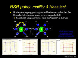 Rso Palsy Motility Hess Test Ppt Video Online Download