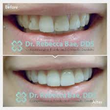 By straightening out your teeth, braces absolutely do change your smile! Smile Gallery Dr Rebecca Bae Butler
