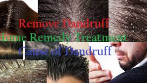 Check spelling or type a new query. How To Remove Dandruff Quickly 2021 Immunity Booster Fitness Blog