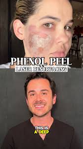 Phenol peels or Lasers? #skinresurfacing #skincare #peel #skincareroutine
