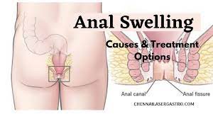 Anal Swelling - Causes and Treatment Options | Chennai Laser Gastro