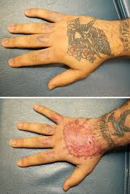 Certified in 2012 with the medlite c6 laser, our providers continue their training and education to ensure they're knowledgeable in the latest tips and techniques. Tattoo Removal Roanoke Va