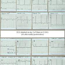 Journal of the american college of cardiology vol. Evidence Of Myocarditis Ecg Abnormalities Download Scientific Diagram