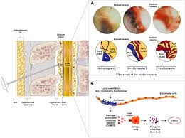 Image result for Chorioamnionitis