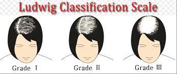 Some types of hair loss are permanent, like male and female pattern baldness. Female Pattern Hair Loss Village Dermatology