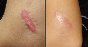 Image result for Reduce the appearance of scars